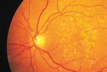 Ojo con degeneración macular (Foto: NEI) Ojo con degeneración macular (Foto: NEI)