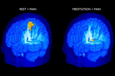 El cerebro dolorido con y sin meditación.| 'The Journal of Neuroscience'