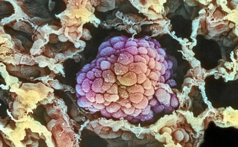 Imagen microscópica de un tumor. | Foto: Science Library.