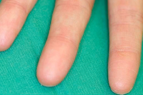 Detalle de la mano de un afectado, sin huellas dactilares. | AJHG